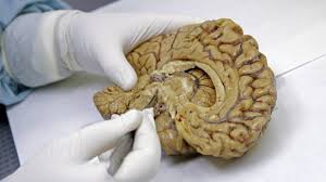 Newfound brain network ‘SCAN’ implicated in Parkinson’s disease